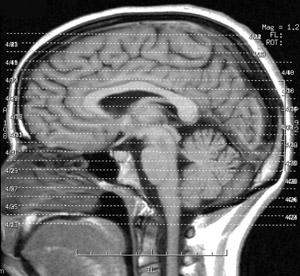 MRI image of a brain