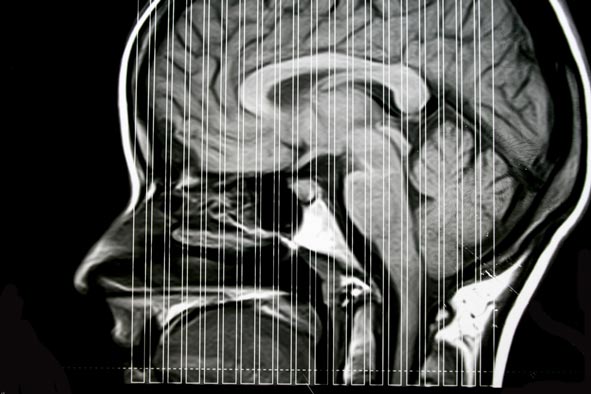 MRI brain scan